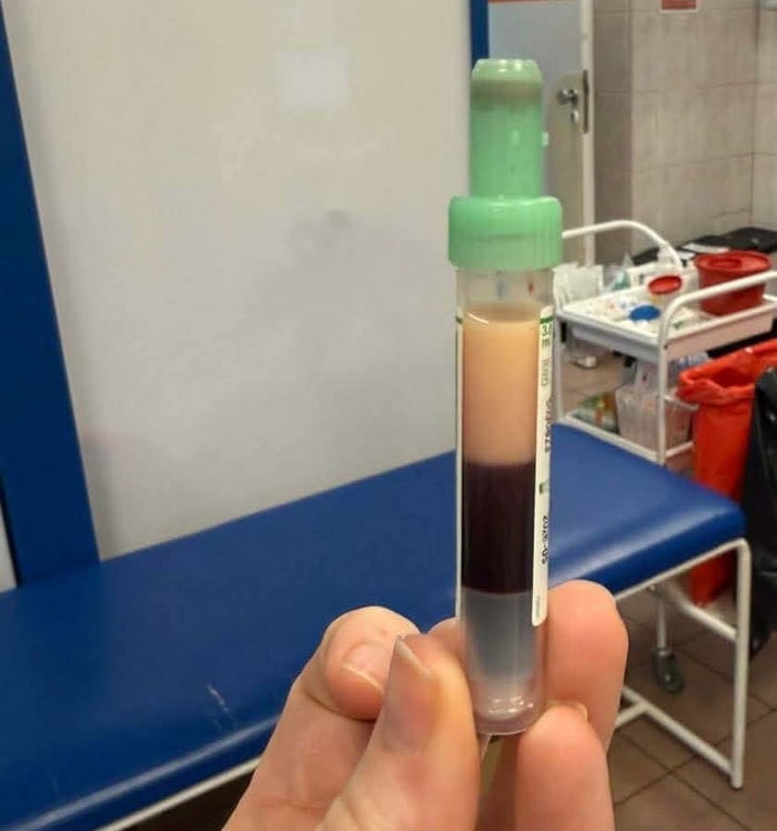 The image displays a hand holding a green-topped medical blood collection tube, which has separated into three distinct, unusual layers: a thin grayish bottom layer, a thick dark purple red blood cell layer, and a large pale beige top layer (far thicker than typical plasma/serum). The background is a clinical setting, featuring a blue exam table and a medical supply cart, confirming this is a real lab/doctor's office environment. This abnormal separation creates an absurd visual joke, as the layered tube strongly resembles a food item like a parfait or layered drink, which is wildly out of place for a blood sample, making it a humorous medical oddity. The unusual layering is likely due to extremely high lipid (fat) levels in the blood, causing the oversized top layer, plus an unexpected bottom component.