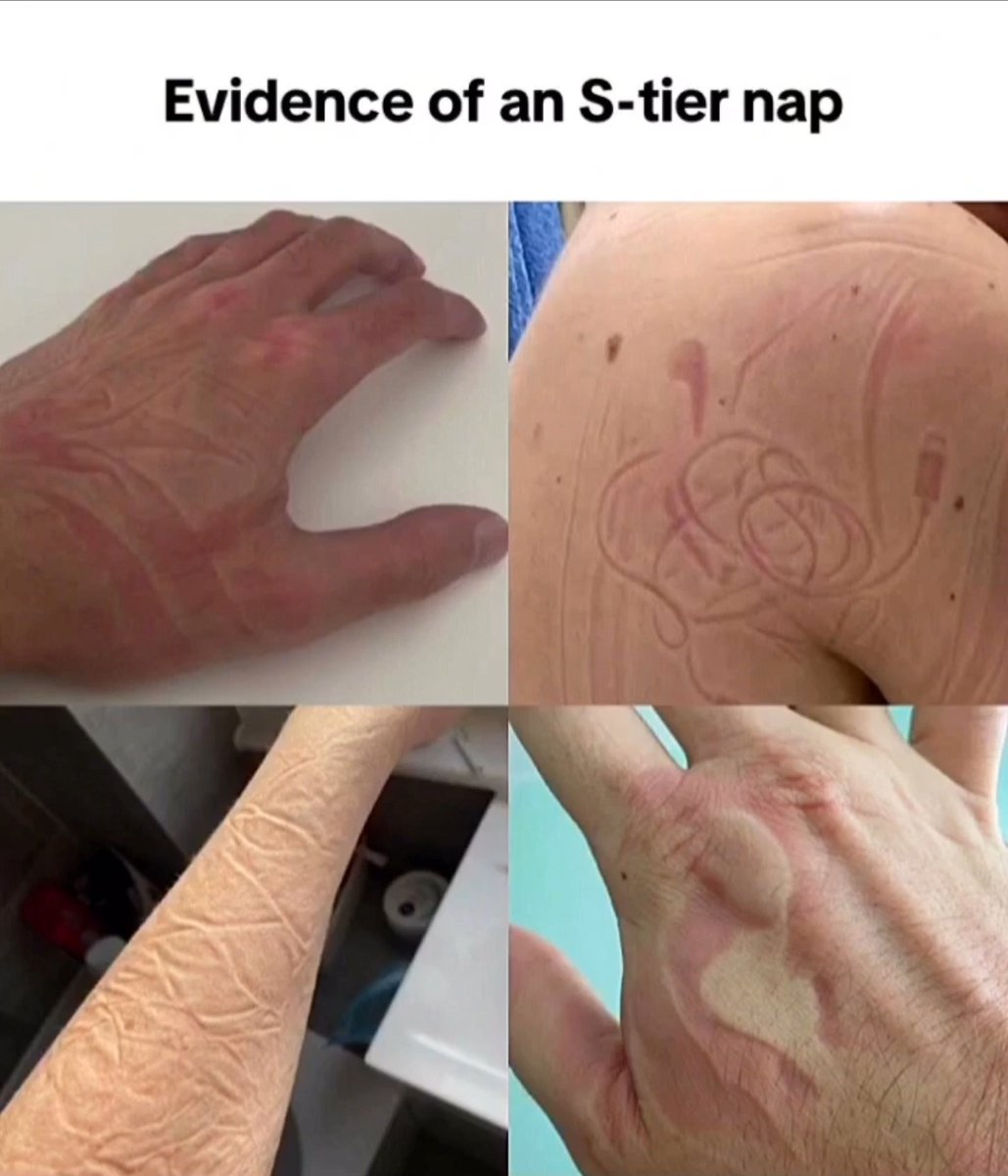 This is a 4-panel collage meme. The top of the image has text reading 'Evidence of an S-tier nap'. Each of the four panels displays a photo of a different part of human skin (two hands, one forearm, one upper back) with deep, distinct, long-lasting creases and fabric or surface imprints left on the skin. The humorous premise is that these prominent, clear imprints prove the person had an extremely deep, restful, high-quality (S-tier, meaning the highest possible tier) nap that lasted long enough for these marks to form on their skin, a relatable experience for many people who take long naps.