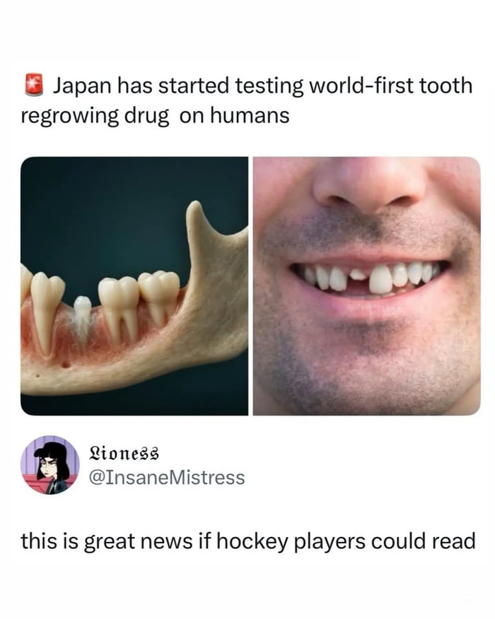 This meme consists of a news headline, two side-by-side images, and a sarcastic comment. The top headline states 'Japan has started testing world-first tooth regrowing drug on humans'. The left image shows a medical model of a human lower jaw with a new tooth growing in the gum line, while the right image is a close-up of a smiling man missing one of his front teeth. Below the images, a comment from user @InsaneMistress (display name Lioness) reads 'this is great news if hockey players could read'. The joke plays on two common tropes: that hockey players frequently have teeth knocked out during games, making them ideal candidates for the tooth regrowing drug, and the unfair stereotypical joke that hockey players are unintelligent and unable to read, so they would not find out about the drug.