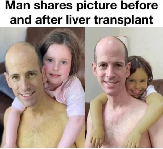 This two-panel meme features top text that reads 'Man shares picture before and after liver transplant'. The left (before transplant) panel depicts a bald father with bright yellow jaundiced skin, a common symptom of severe liver disease, carrying his young daughter who has normal pale skin on his back. The right (after transplant) panel shows the same father now with normal pale skin, carrying his daughter who now has bright yellow jaundiced skin. The gag is an absurdist dark pun: instead of receiving a healthy liver to cure his jaundice, the meme implies the father literally transferred his liver disease and associated yellow skin to his daughter. The joke fits the 'yellow humor' label, playing both on the yellow color of jaundiced skin and the term for off-color/dark comedy.