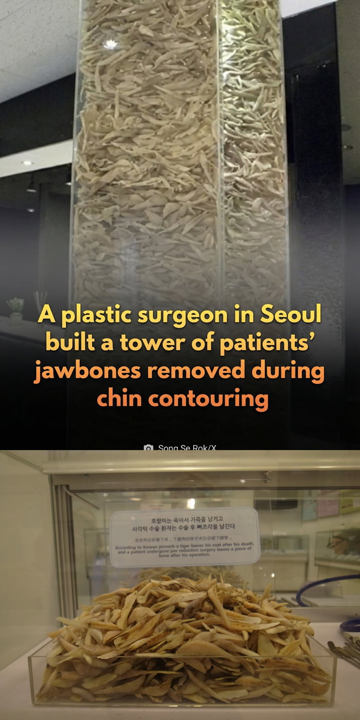 This meme is a two-image compilation showcasing a surreal and shocking display from a Seoul plastic surgeon's clinic. The upper image features a tall, transparent tower filled with hundreds of small jawbone fragments, paired with overlay text stating: 'A plastic surgeon in Seoul built a tower of patients’ jawbones removed during chin contouring'. The lower image is a close-up of a smaller container of these fragments, accompanied by a bilingual plaque that shares a darkly humorous anecdote linking Korean folklore to cosmetic surgery patients. The meme leans into the unsettling, bizarre nature of preserving and displaying these human body parts, creating a darkly humorous viral curiosity.
