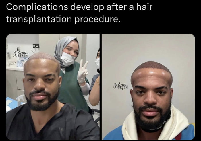 A two-panel meme humorously depicting 'complications' after a hair transplant. The left panel shows a man in a medical setting with a shaved head featuring visible transplant marks, surrounded by medical staff (one wearing a hijab and making a peace sign). The right panel shows the same man with an unusually smooth, hairless head, implying the 'complication' is an overdone or unsuccessful transplant result. The top text 'Complications develop after a hair transplantation procedure.' sets up the sarcastic joke, contrasting the expected medical issue with the trivial, funny outcome of a too-smooth scalp.