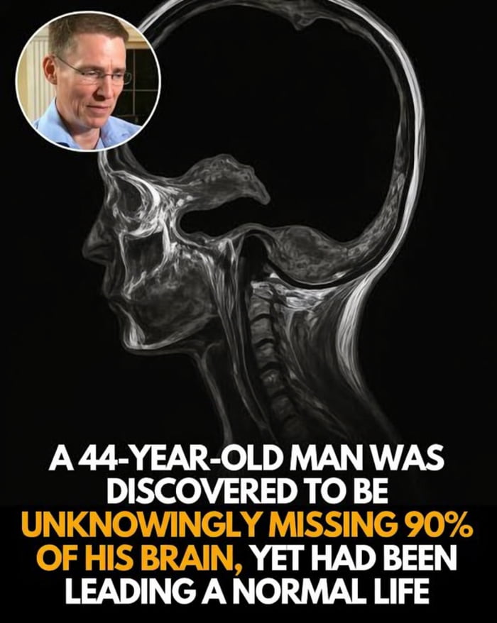 The meme features a grayscale side-view MRI scan of a human skull showing a severely shrunken brain that only occupies roughly 10% of the cranial cavity, paired with a small circular headshot of a 44-year-old man in the top left corner. Bold text below the MRI states that the man had no idea he was missing 90% of his brain, and had been living a completely normal, functional life before his condition was discovered. The joke frames this rare medical case as a relatable gag, implying that people can navigate daily life successfully even when operating on minimal mental effort, which the title refers to as 'easy mode' life.