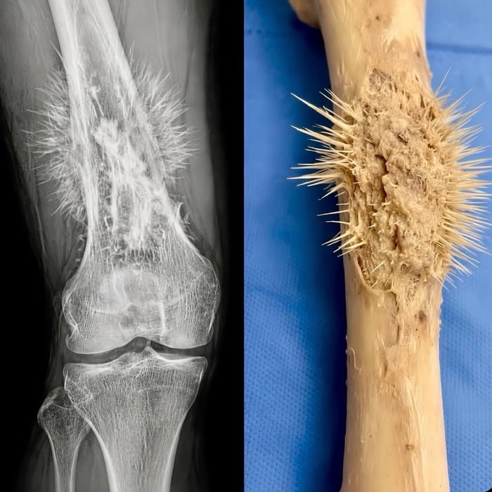The image presents a side-by-side comparison of two views of an osteosarcoma (bone cancer) lesion on a human femur (thigh bone). The left panel is a medical X-ray showing the femur near the knee joint, with a characteristic 'sunburst' pattern of sharp, spiky abnormal bone growth extending outward from the main bone surface. The right panel is a photograph of an actual excised bone specimen, showing the same type of sharp, spiky, porous abnormal growth protruding from the bone, matching the appearance seen in the X-ray. The spiky growth would severely irritate surrounding soft tissue, leading to extreme pain, as referenced in the original post title.